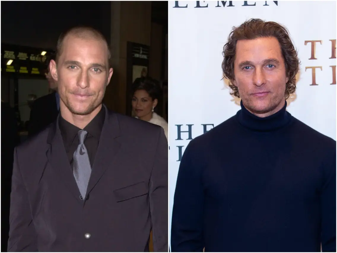 Matthew Mcconaughey plastic surgery